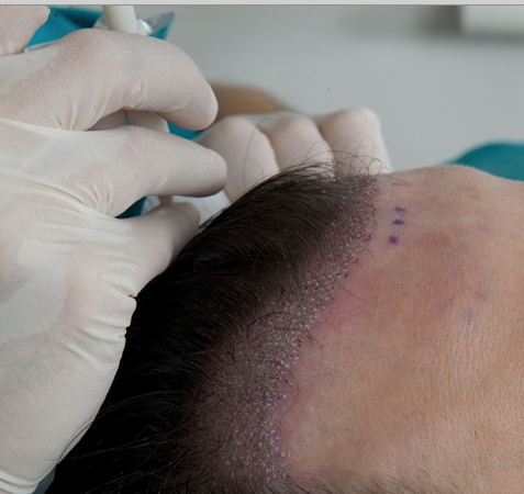 Trapianto Capelli FUSS