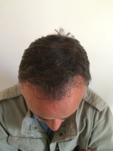 Trapianto Capelli Roma Caso Post 6 Mesi